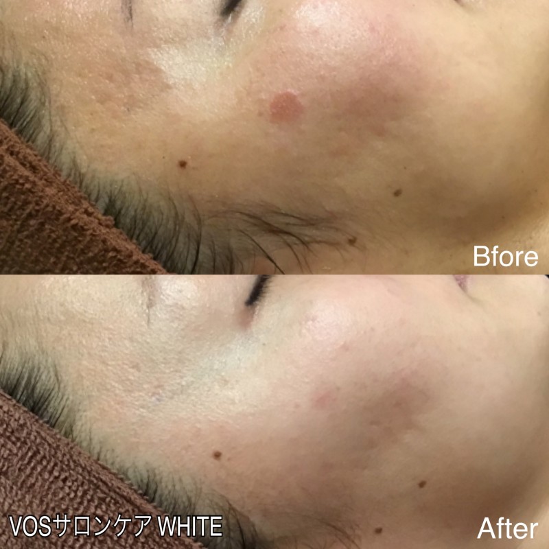 VOSサロンケア💎WHITE💎Before/After - Soyeux ソワイユ東銀座店│東京